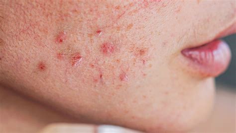 Acne Scar Treatment In Singapore Removal Solutions