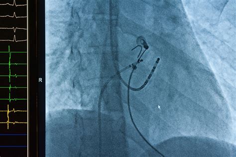 Cardiac Ablation — Hurstville Private Heart Centre · Cardiology · South Sydney