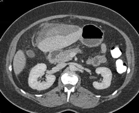 Metastatic Carcinoid Tumor To The Liver With Spontaneous Hepatic Bleed