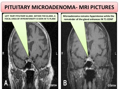 PITUITARY ADENOMA RADIOTHERAPY PLANNING