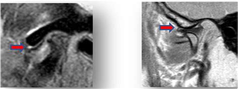 MRI right side TMJ before treatment Fig. 4. MRI left side TMJ before ...