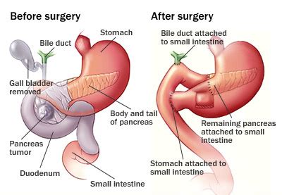 Pancreatic Whipple Surgery In Dombivli Whipple Procedure In Dombivli