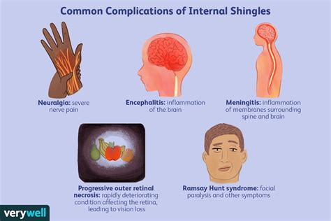 What Is Internal Shingles?