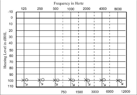 Audiogram of a WS individual with sensorineural bilateral symetric... | Download Scientific Diagram