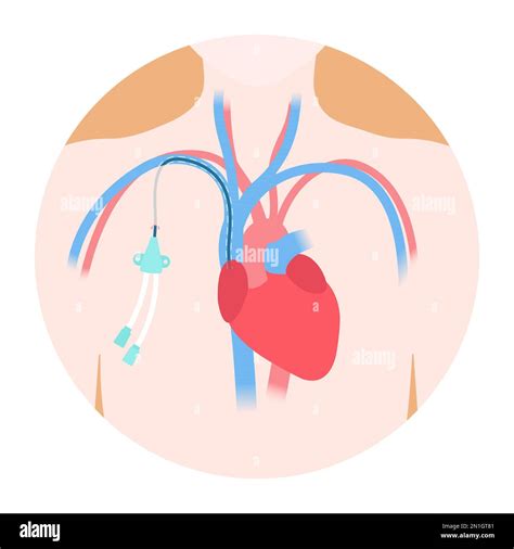 Central Venous Catheter Banque Dimages Détourées Alamy