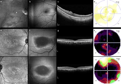 Diagnostics Free Full Text Bull’s Eye Maculopathy In Near Infrared Reflectance As An Early