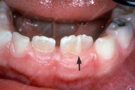 Twinned Tooth Stock Image C0393027 Science Photo Library