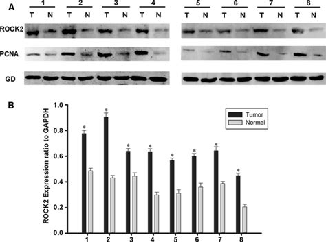 Rock And Pcna Expression In Human Gastric Cancer By Western Blot