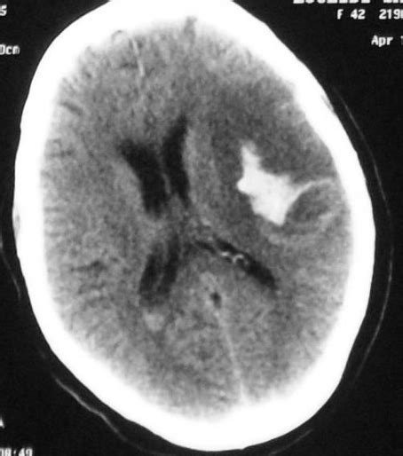 Figure 1 From Subarachnoid Hemorrhage Revealing A Bacterial Endocarditis Case Report With