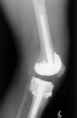 The Use Of Impaction Grafting In Revision Total Knee Arthroplasty The