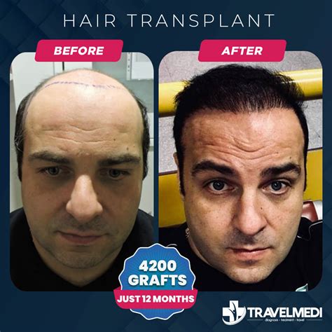 Hair Transplant In Turkey Prices Before After 2024