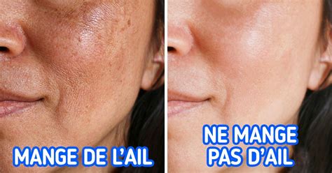 Les Causes De La Pigmentation De La Peau Et Fa Ons De L Viter Sympa