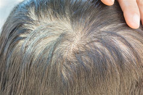 Diffuse Thinning Why It Happens And How To Treat It Myhair