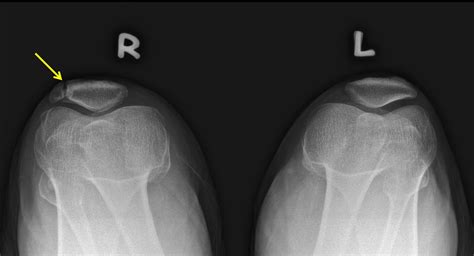 Bipartite Patella Radiology Cases