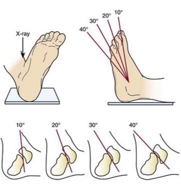 Adult Ankle Radiographs Trauma Orthobullets Hot Sex Picture