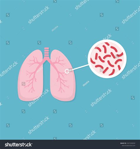 Lungs Of Infected Person Mycobacterium Royalty Free Stock Vector