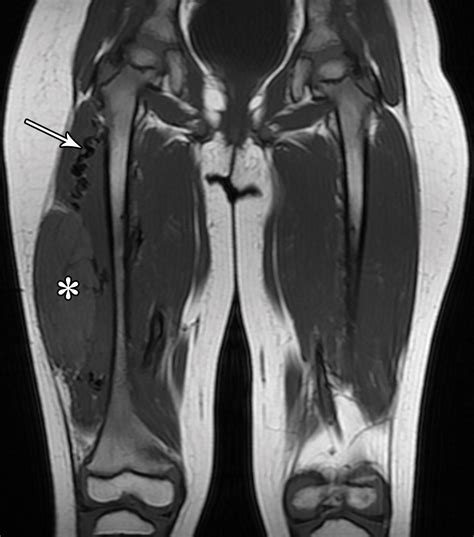 Mri Of Rhabdomyosarcoma And Other Soft Tissue Sarcomas In Children