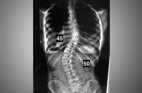 Escoliose Sintomas Diagn Stico Dr Luciano Pellegrino