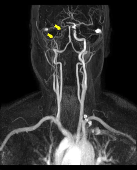 The Brain Magnetic Resonance Angiography Shows Stenosis Of The Right