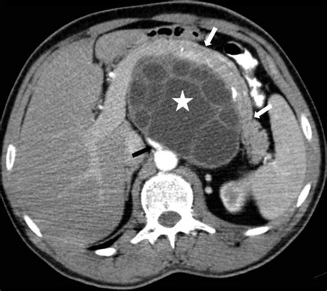 Primary Retroperitoneal Hydatid Cyst The American Journal Of The