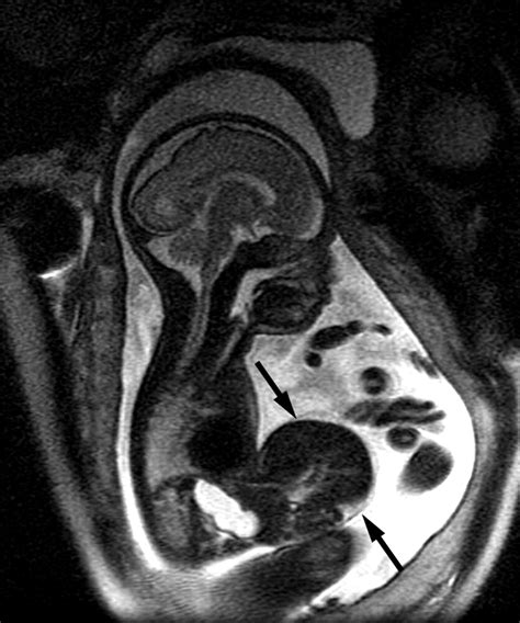 Prenatal Mri Of Congenital Abdominal And Chest Wall Defects Ajr