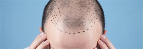 3 Hair Transplant Failures Why And How Often Do They Happen Unitedcare