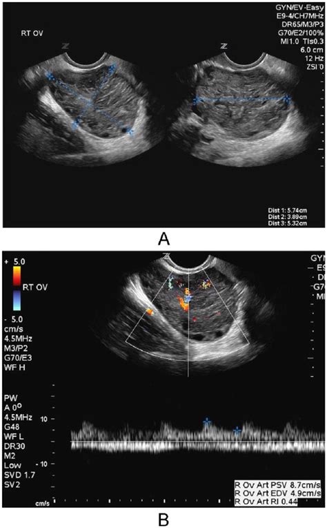 Ovarian Torsion With Persistent Parenchymal Blood Flow Marianna