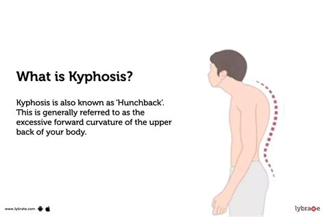 Kyphosis: Symptoms, Causes, Exercises, And More, 57% OFF