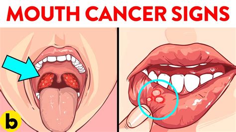 Pictures Of Early Signs Of Tongue Cancer - Infoupdate.org