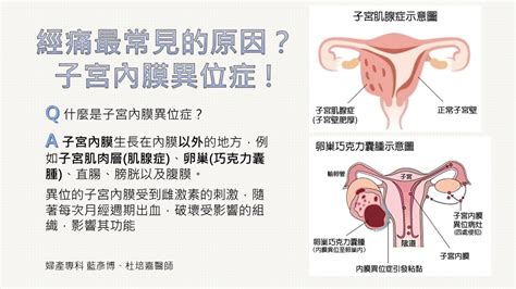 婦產專科 藍彥博、杜培嘉醫師 經痛最常見的原因就是子宮內膜異位症，內膜異位症包含肌腺症、巧克力囊腫，嚴重時會造成不 Facebook