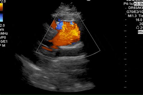 Aortic Dissection Ultrasound