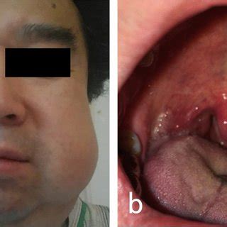 Resolution of swelling around the left buccal area was observed (a) and... | Download Scientific ...