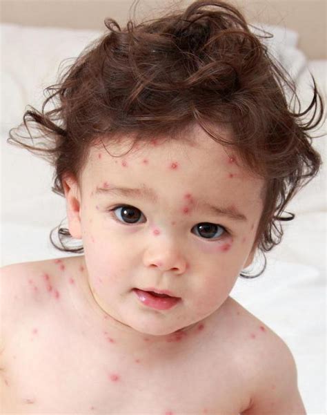 Герпес у ребенка: типы, симптомы и лечение