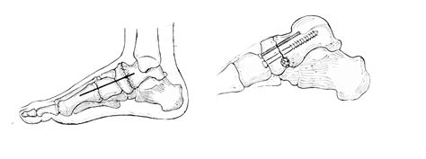 Navicular-Cuneiform Joint Fusion — South West Foot Surgery