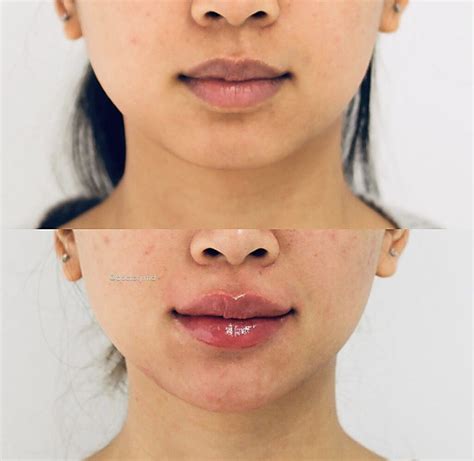 Chin Enhancement Filler Treatment Vancouver One Clinic Md