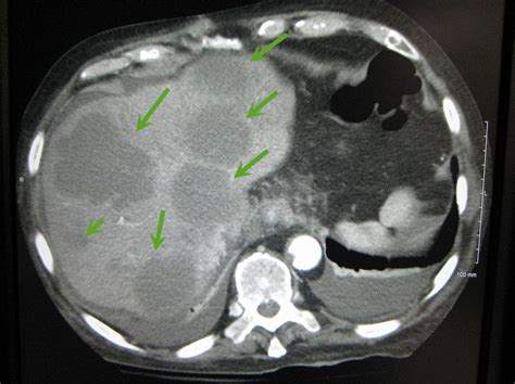 Liver Metastases Ucsf Department Of Surgery