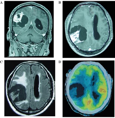 Figure From Peritumoral Cystic Meningioma A Report Of Two Cases And