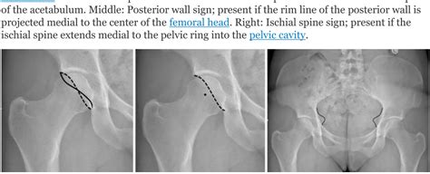 Figure 1. Radiographic signs of acetabular retroversion in AP ...