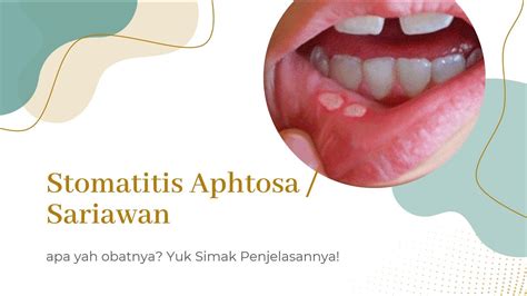 Stomatitis Aphtosa Sariawan Apa Yah Obatnya Yuk Simak