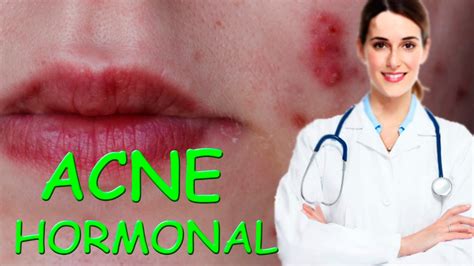 Como Tratar El Acne Hormonal En Mujeres