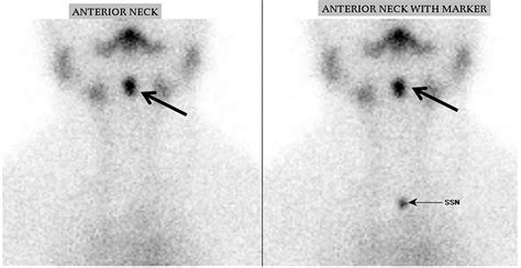 Lingual Thyroid Associated With Hypothyroidism As A Cause For Short