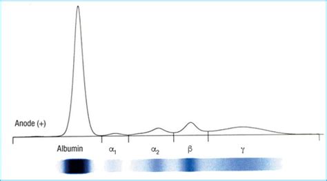 What Is A Serum Protein Electrophoresis SPEP The Blood Project