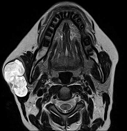 Pleomorphic Adenoma Parotid Gland Radiology Case Radiopaedia Org