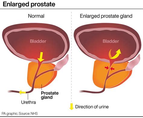 Jump In Searches For ‘enlarged Prostate Following Kings Revelation