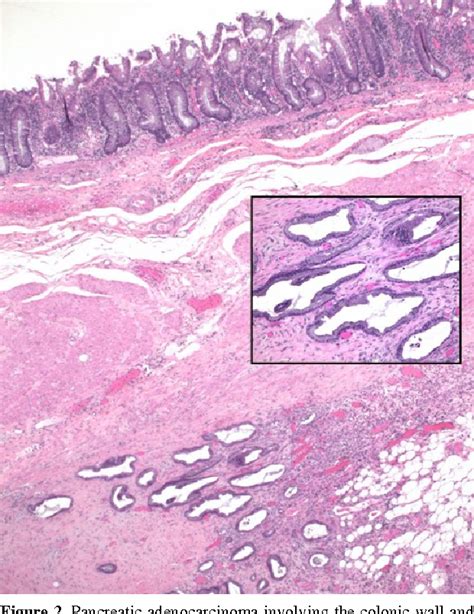 Figure 1 From Carcinoma Of The Tail Of The Pancreas Presenting As Acute