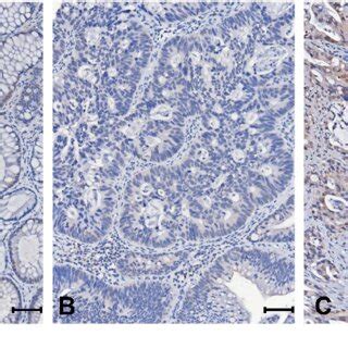 Immunohistochemical Expression Of Ubd Representative Images Of Rectal