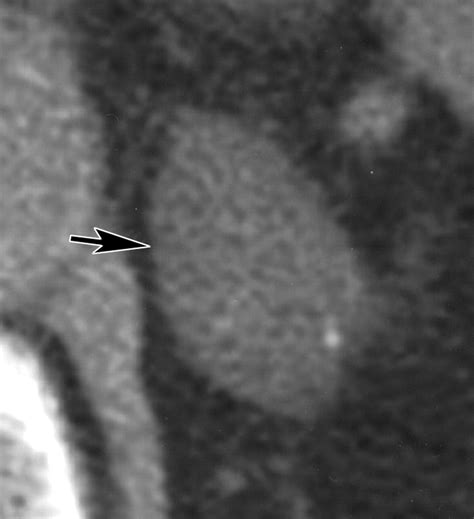 Changing Role Of Imaging Guided Percutaneous Biopsy Of Adrenal Masses