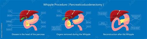 Whipple Procedure Pancreaticoduodenectomy Pancreatic Cancer Treatment