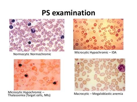 Hypochromic Anemia