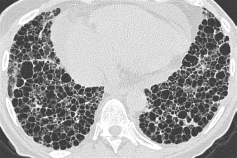 Ct Features Of The Usual Interstitial Pneumonia Pattern Differentiating Connective Tissue